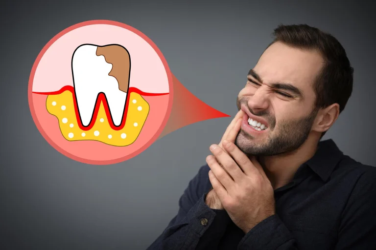How Long Until a Tooth Infection Kills You